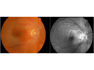 左眼视物不见，右眼视物不清一年(图1)