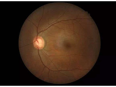 双眼青光眼术后视物不清两年余(图1)