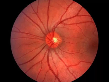 视网膜色素变性你了解多少呢？(图1)