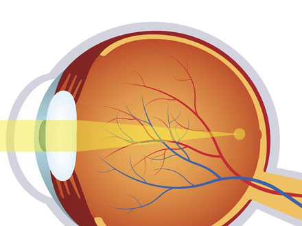 视网膜血管炎究竟有什么症状呢?(图1)