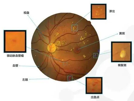 视网膜水肿怎么缓解 视网膜水肿的几个缓解方法(图1)