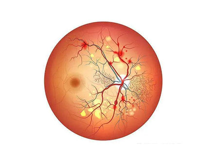 糖尿病性视网膜病变会视网膜水肿吗