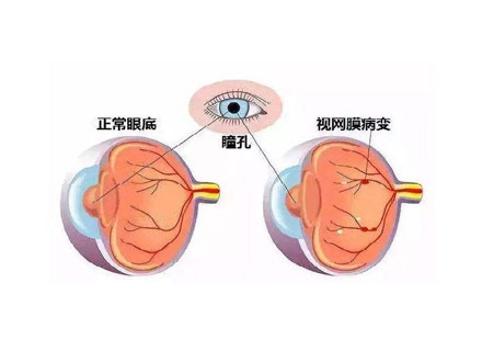 糖尿病性视网膜病变是近视眼吗 认清两种眼疾区别